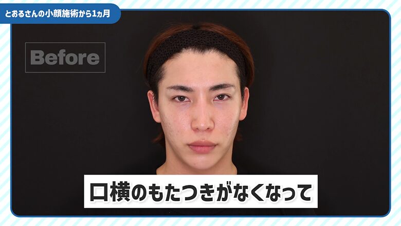 施術前の正面写真