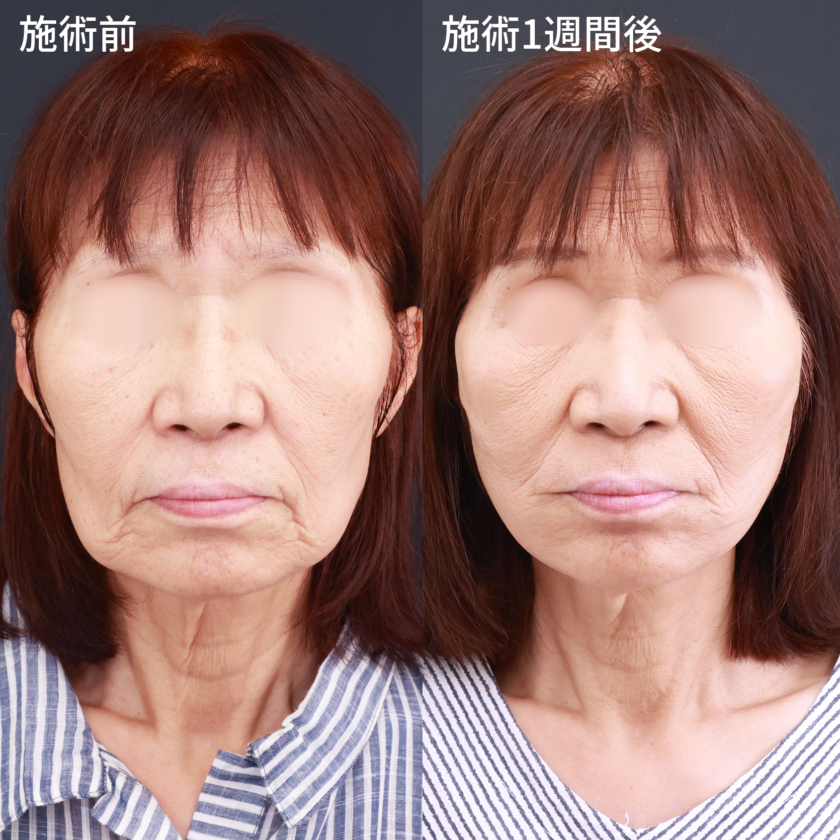 【糸リフト・ヒアルロン酸】シワ・たるみ改善で若返り