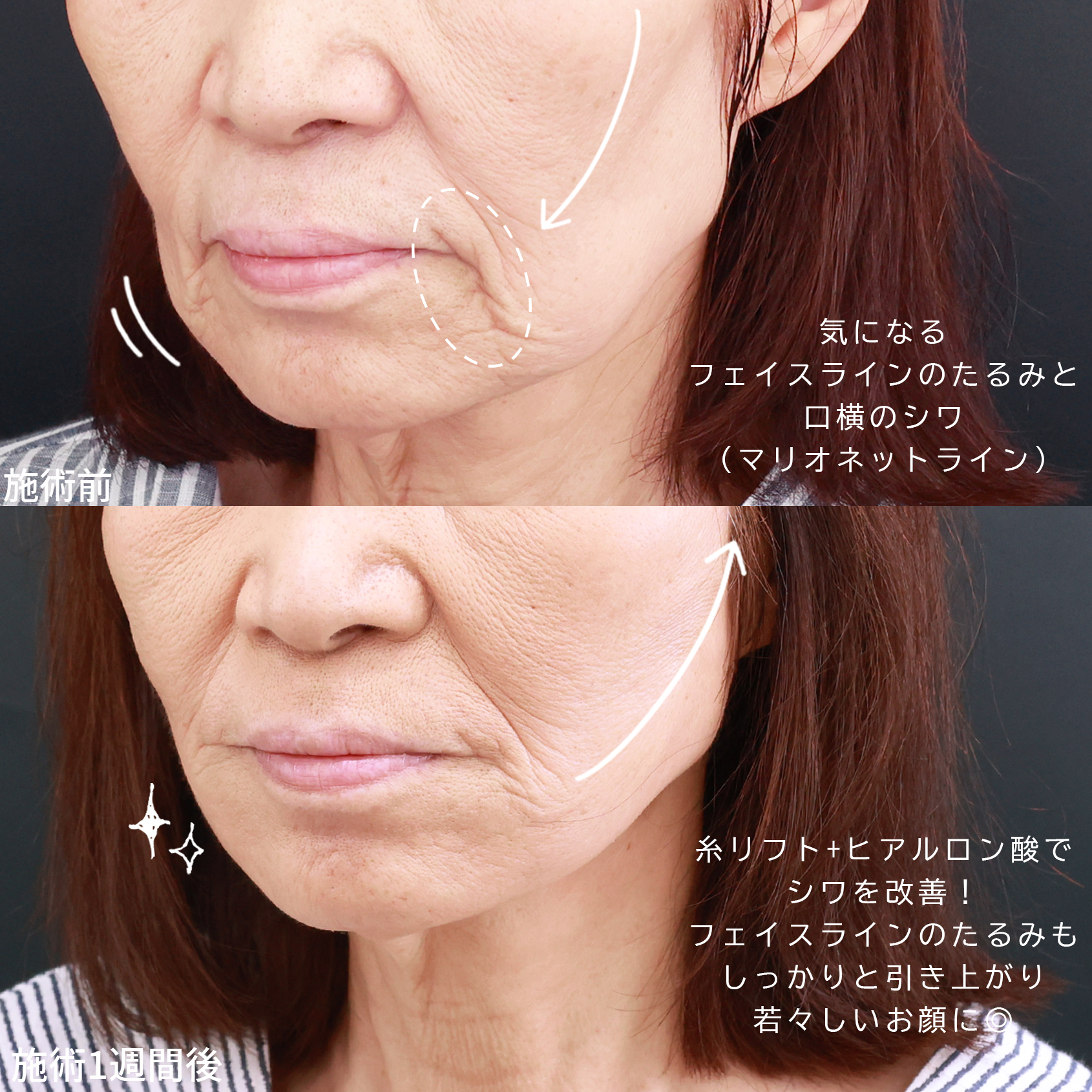 TAC式 ツヤ肌コラーゲンリフト®/マリオネットラインのヒアルロン酸注射の症例写真 施術前後 