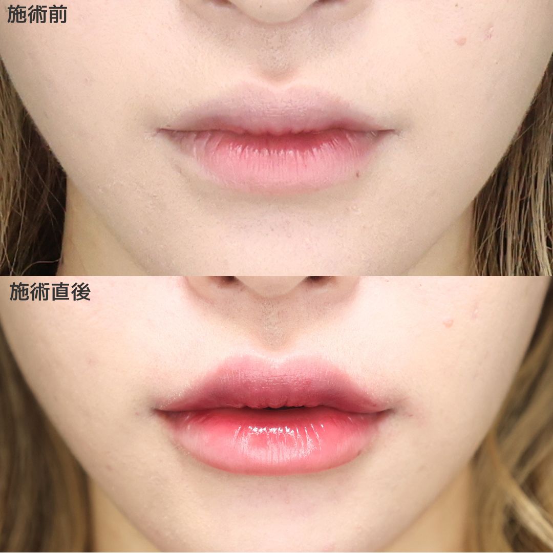 《ヒアルロン酸注射》ぷるぷるリップ