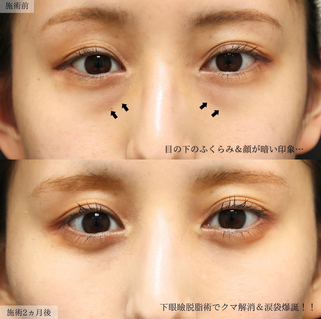 下眼瞼脱脂術（目の下のたるみ取り・目の下の脂肪ふくらみ取り）の症例写真 施術前後 