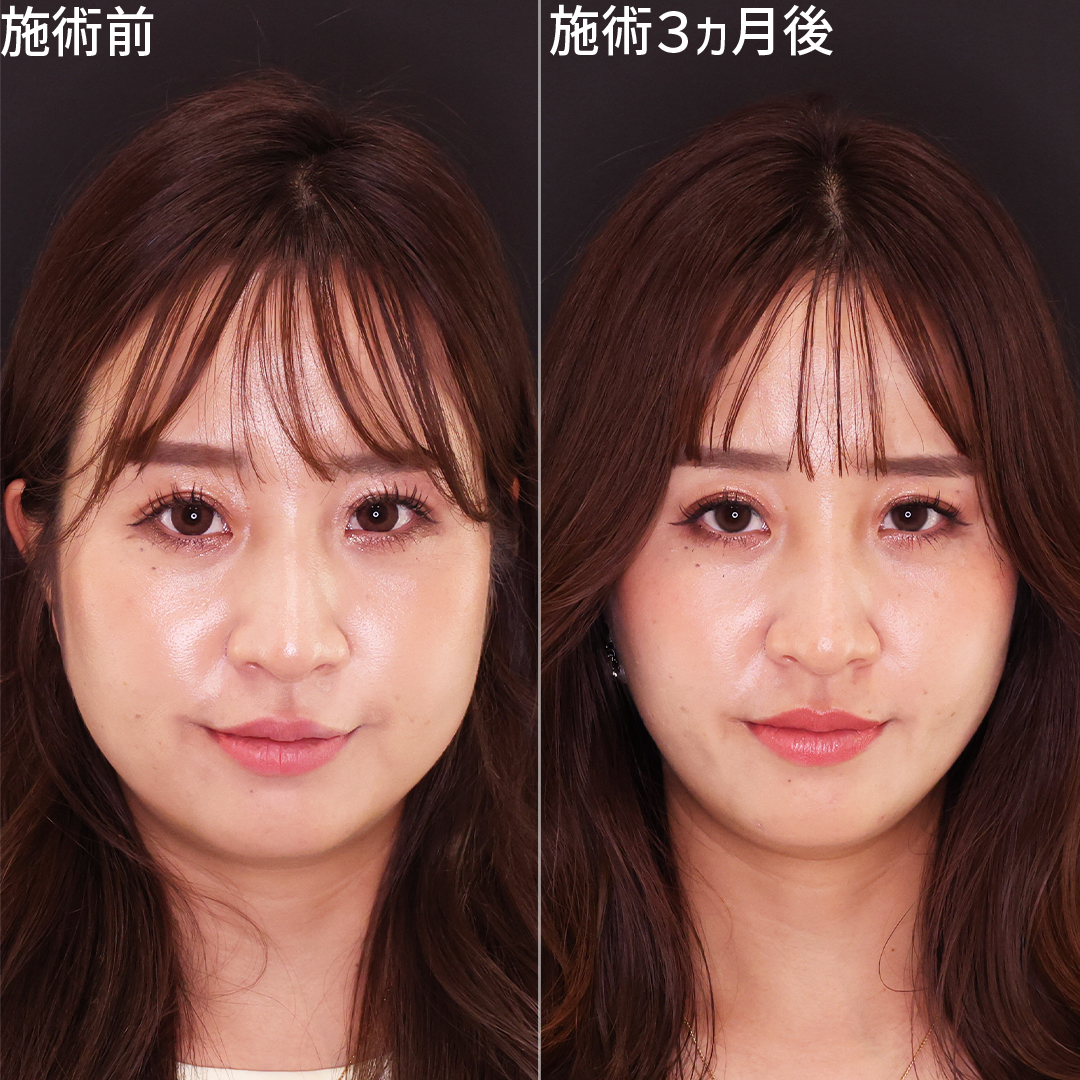 【パーフェクトフェイスライン】口横のたるみを美しくスッキリするならDr.森‼️