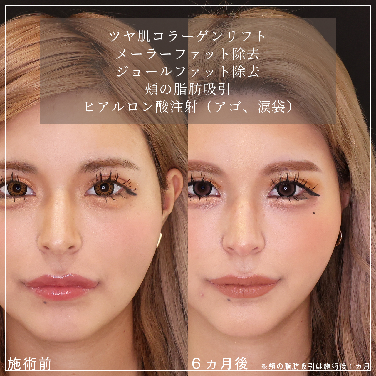 TAC式 ツヤ肌コラーゲンリフト®/メーラーファット除去/ジョールファット除去の症例写真 施術前後 