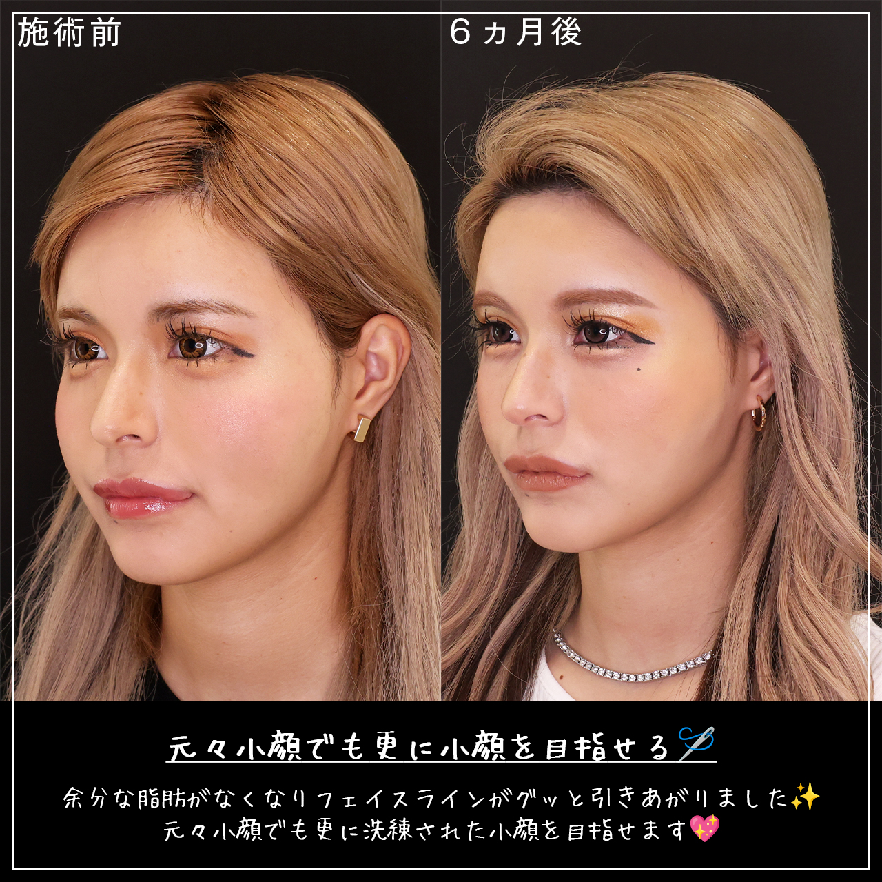 TAC式 ツヤ肌コラーゲンリフト®/メーラーファット除去/ジョールファット除去の症例写真 施術前後 