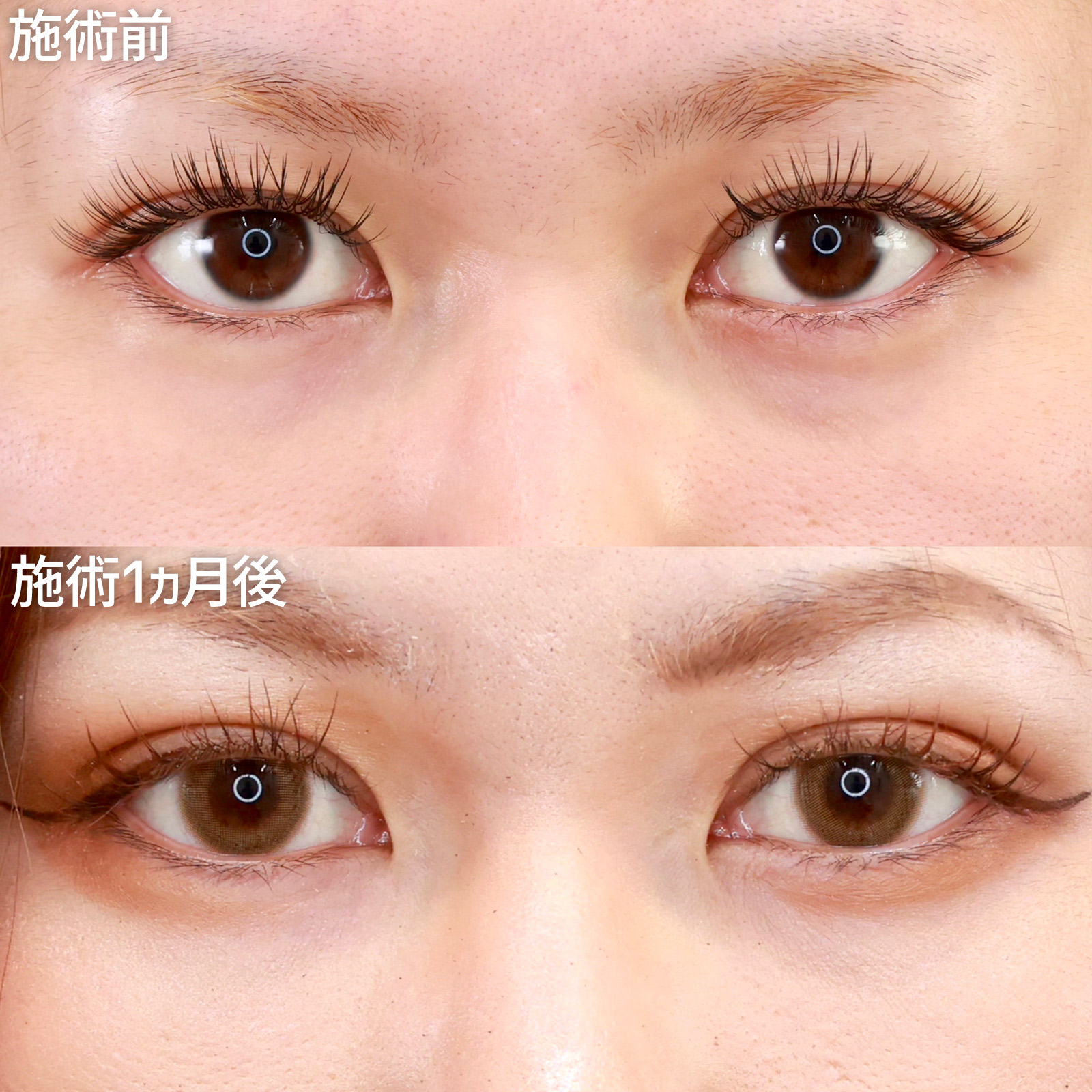 【二重埋没法】毎日のアイテープも卒業！理想的な幅広の平行二重に大変身！