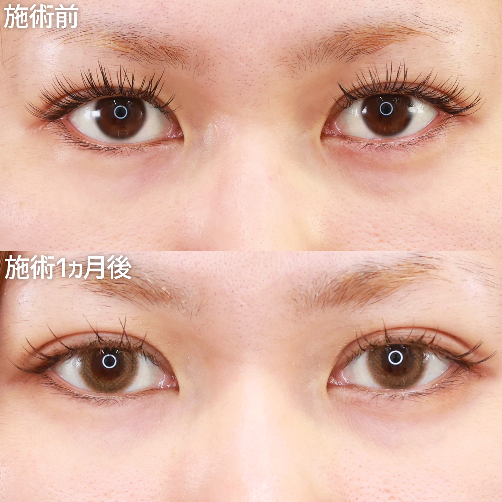 二重埋没法の症例写真 施術前後 