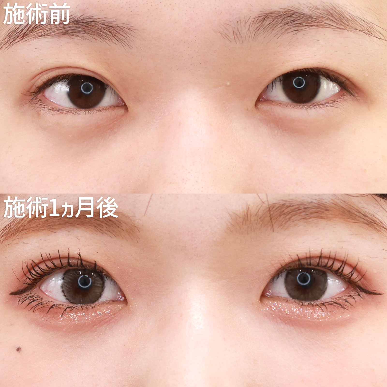 【二重埋没法】安定しない二重ラインをしっかり固定！いつでも理想的な目元に。