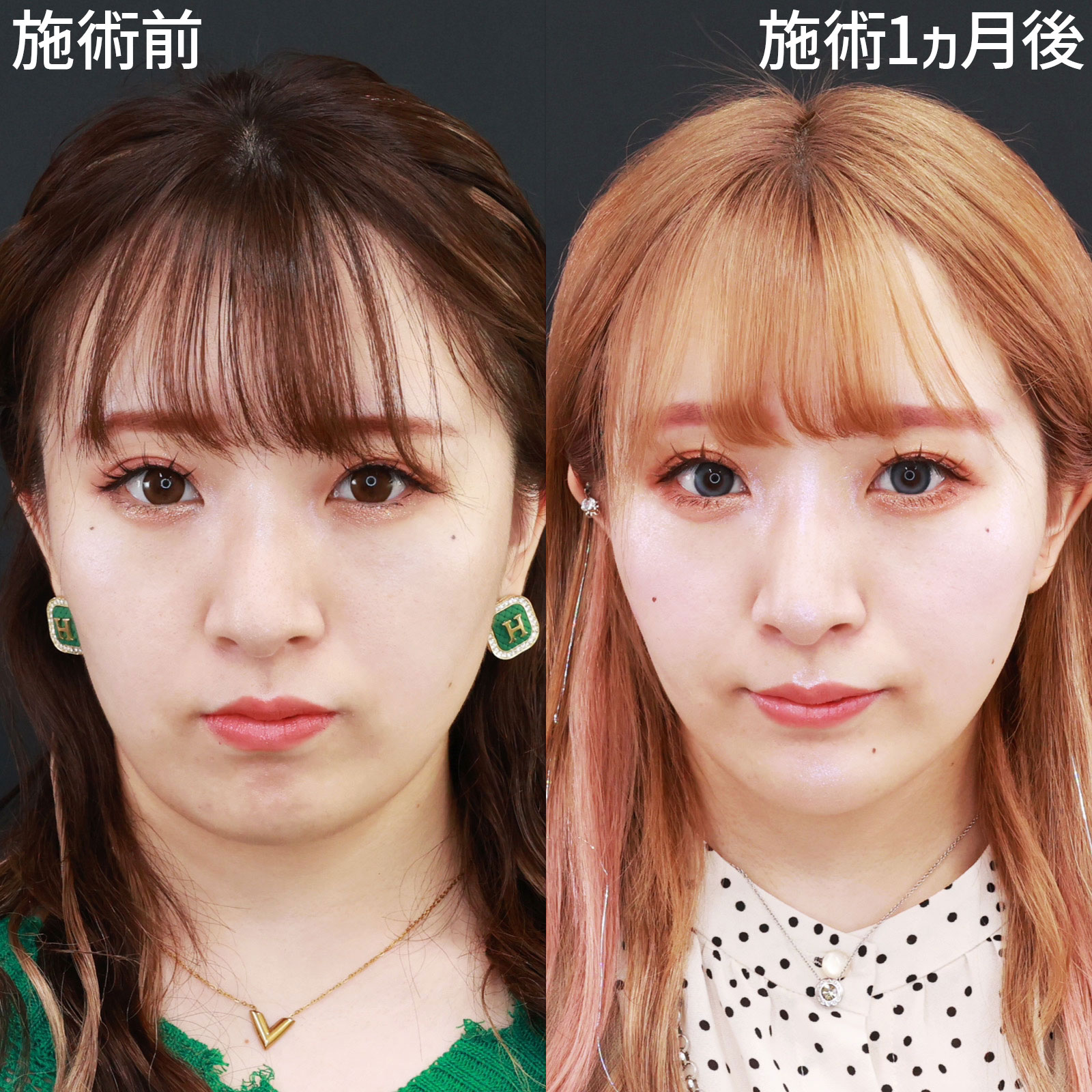 【糸リフト極＆脂肪吸引】何だか痩せた？整形バレしないナチュラル小顔整形ならお任せ！