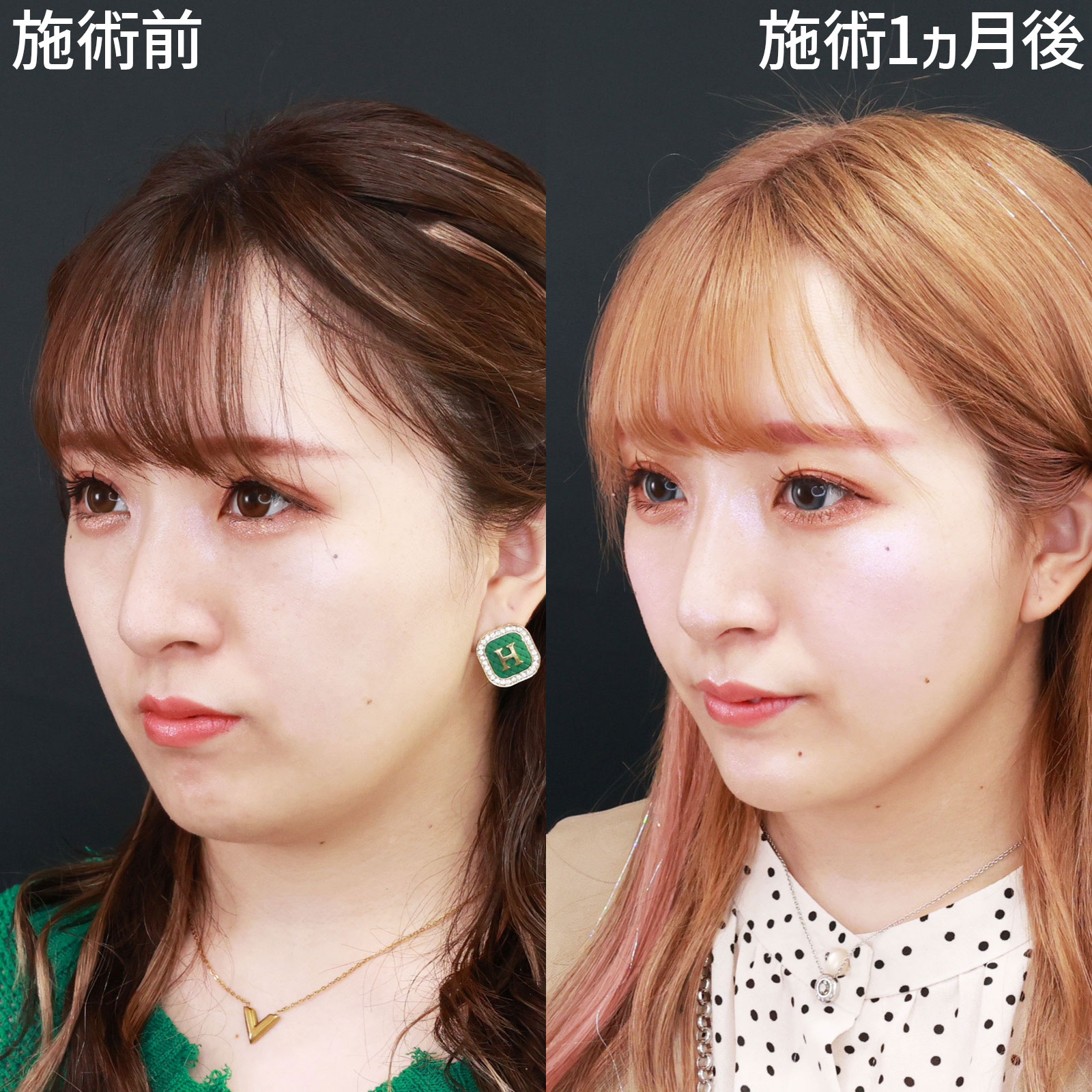 小顔整形｜パーフェクトフェイスライン/TAC式 ツヤ肌コラーゲンリフト®/ジョールファット除去の症例写真 施術前後 