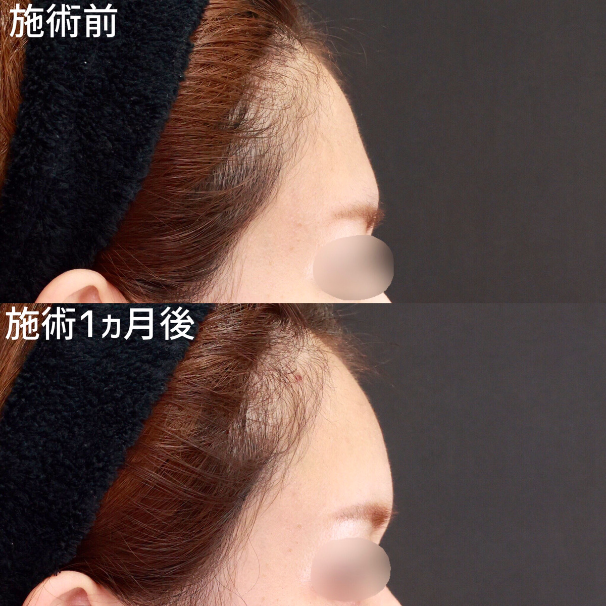 おでこの脂肪注入（オルチャンデコ形成）の症例写真 施術前後 