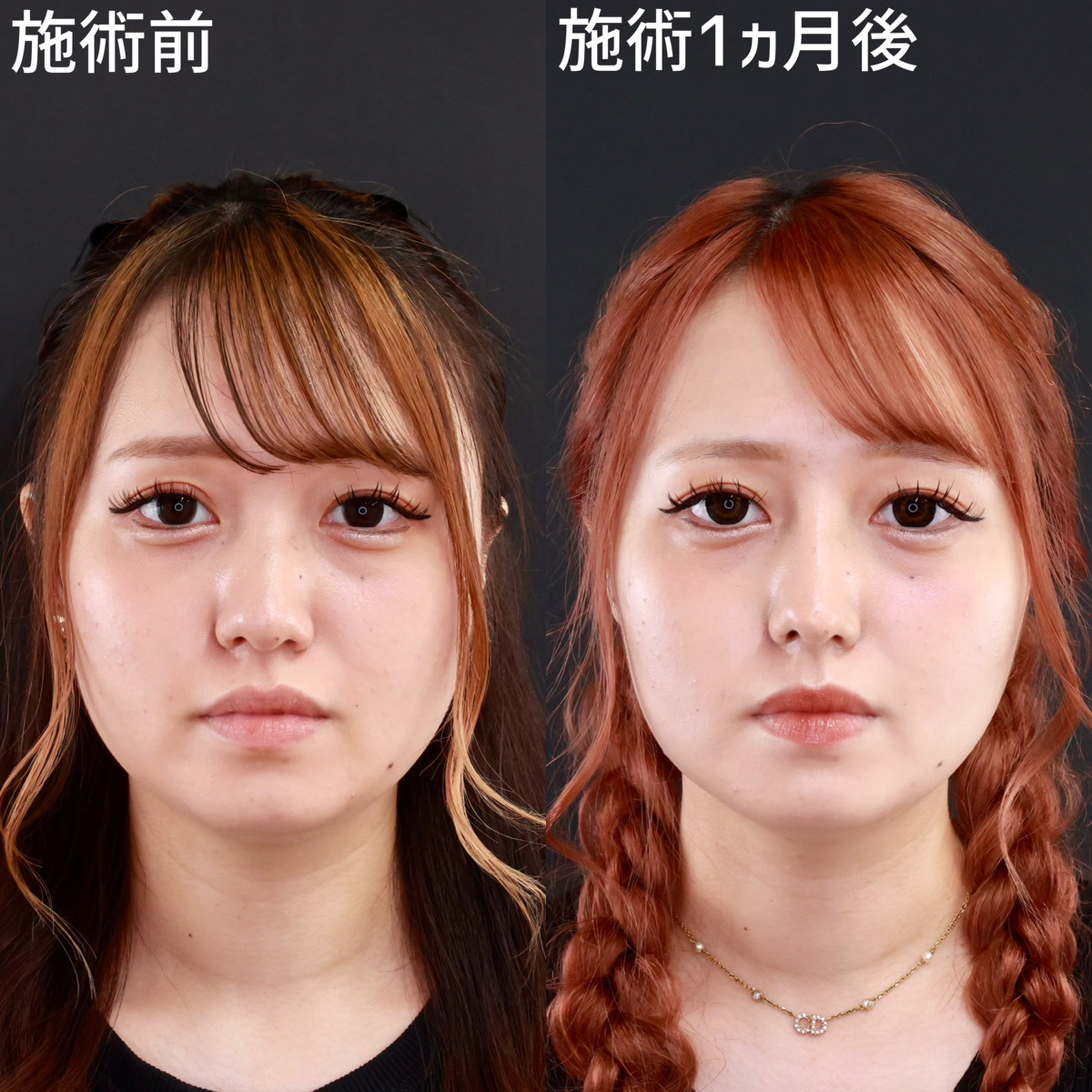 鼻尖形成・鼻尖縮小/鼻先軟骨移植/鼻中隔延長術の症例写真 施術前後 