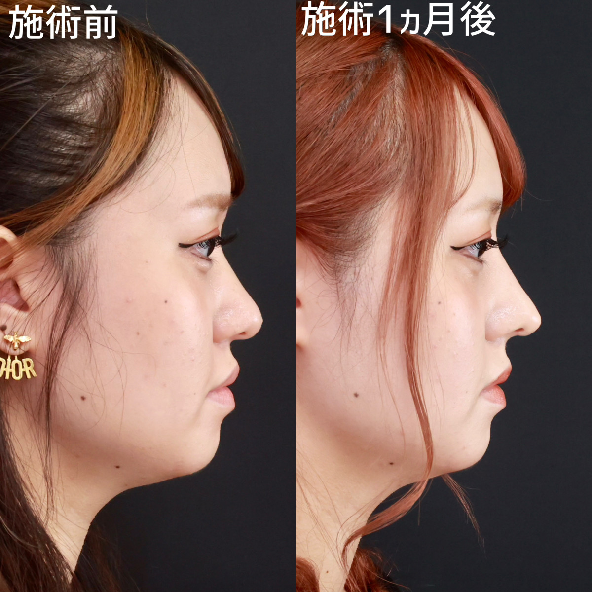 鼻尖形成・鼻尖縮小/鼻先軟骨移植/鼻中隔延長術の症例写真 施術前後 