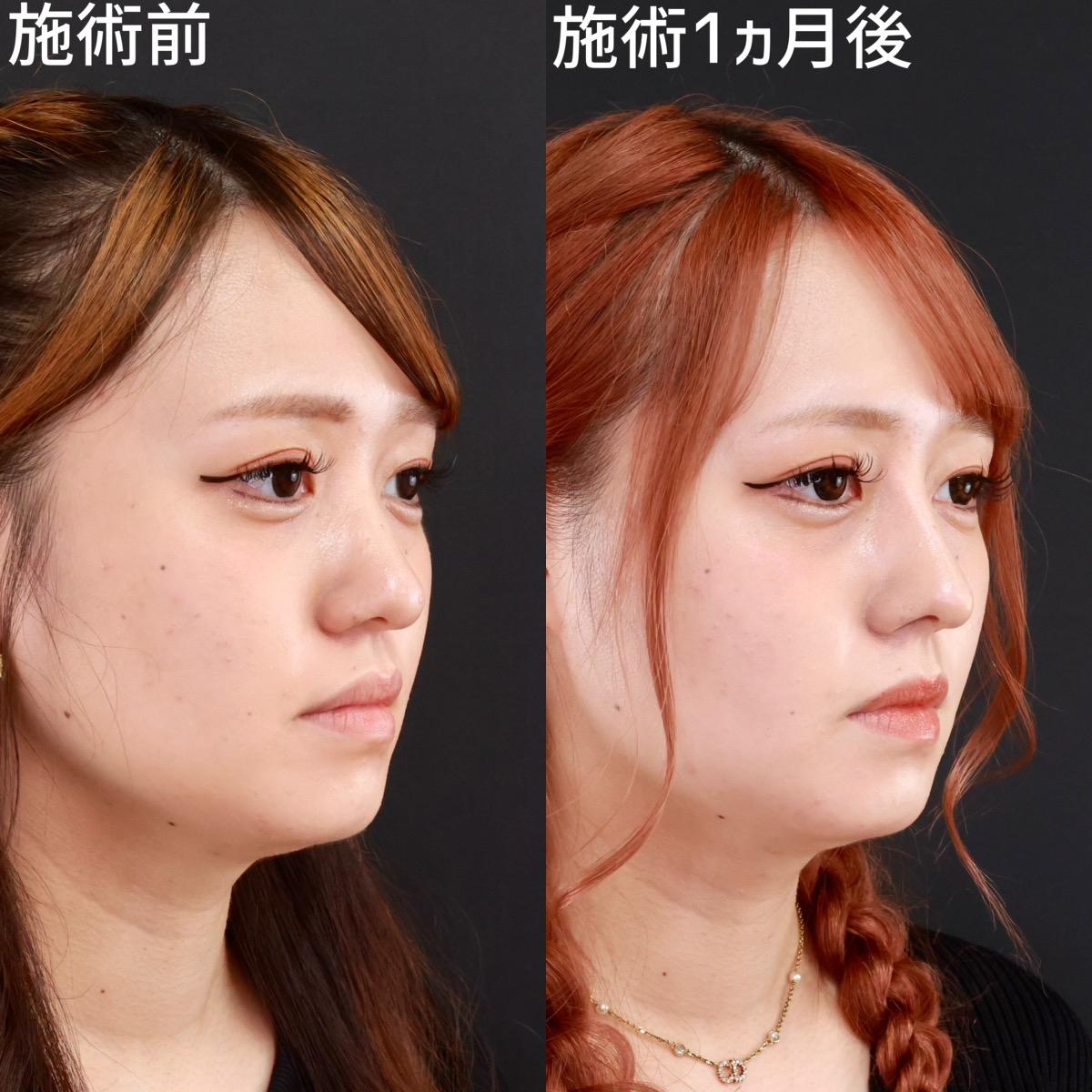 鼻尖形成・鼻尖縮小/鼻先軟骨移植/鼻中隔延長術の症例写真 施術前後 