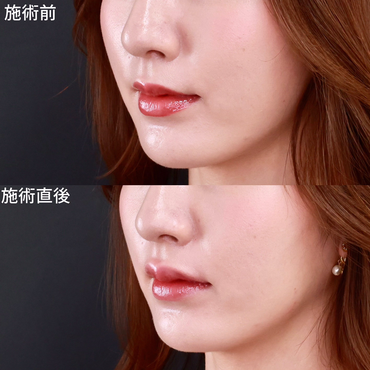 【ヒアルロン酸注射】ぷっくり可愛い唇に