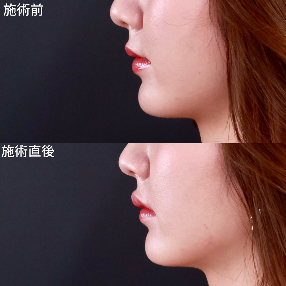 ヒアルロン酸注射：その他の症例写真 施術前後 