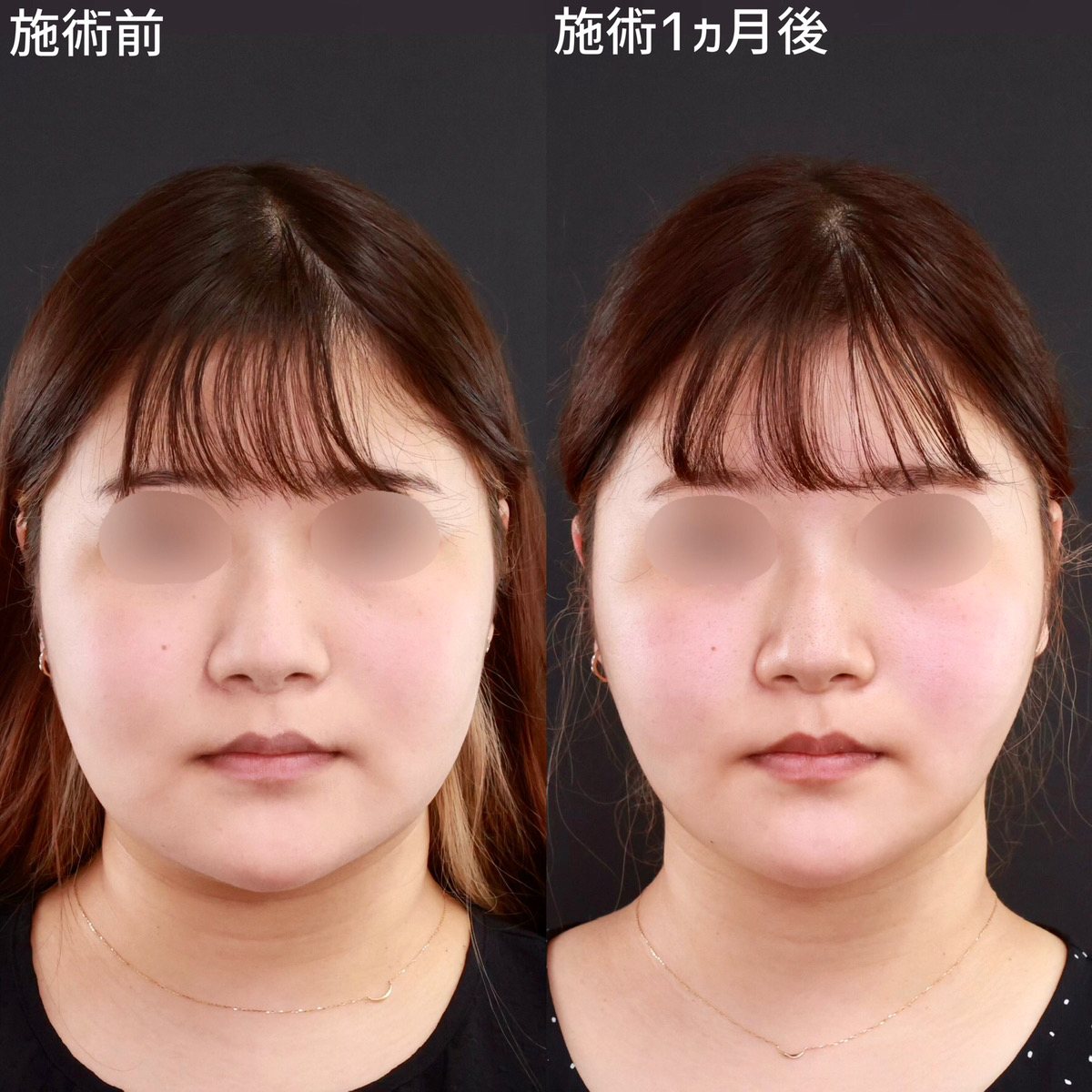 【小顔整形】ひとまわり小さく理想の小顔に