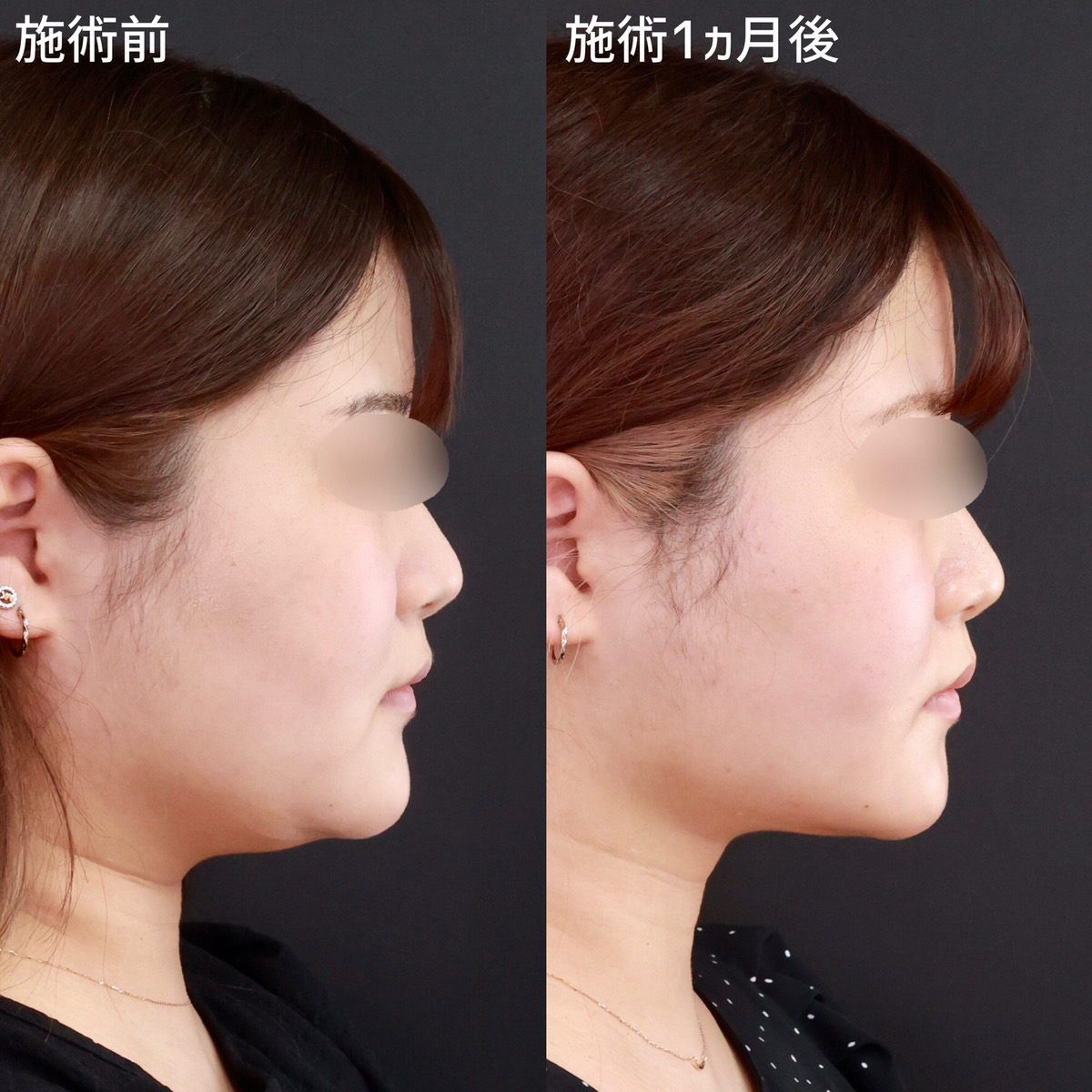 小顔整形｜パーフェクトフェイスライン/TAC式 ツヤ肌コラーゲンリフト®/Lラインファット除去（エラ下脂肪除去）の症例写真 施術前後 