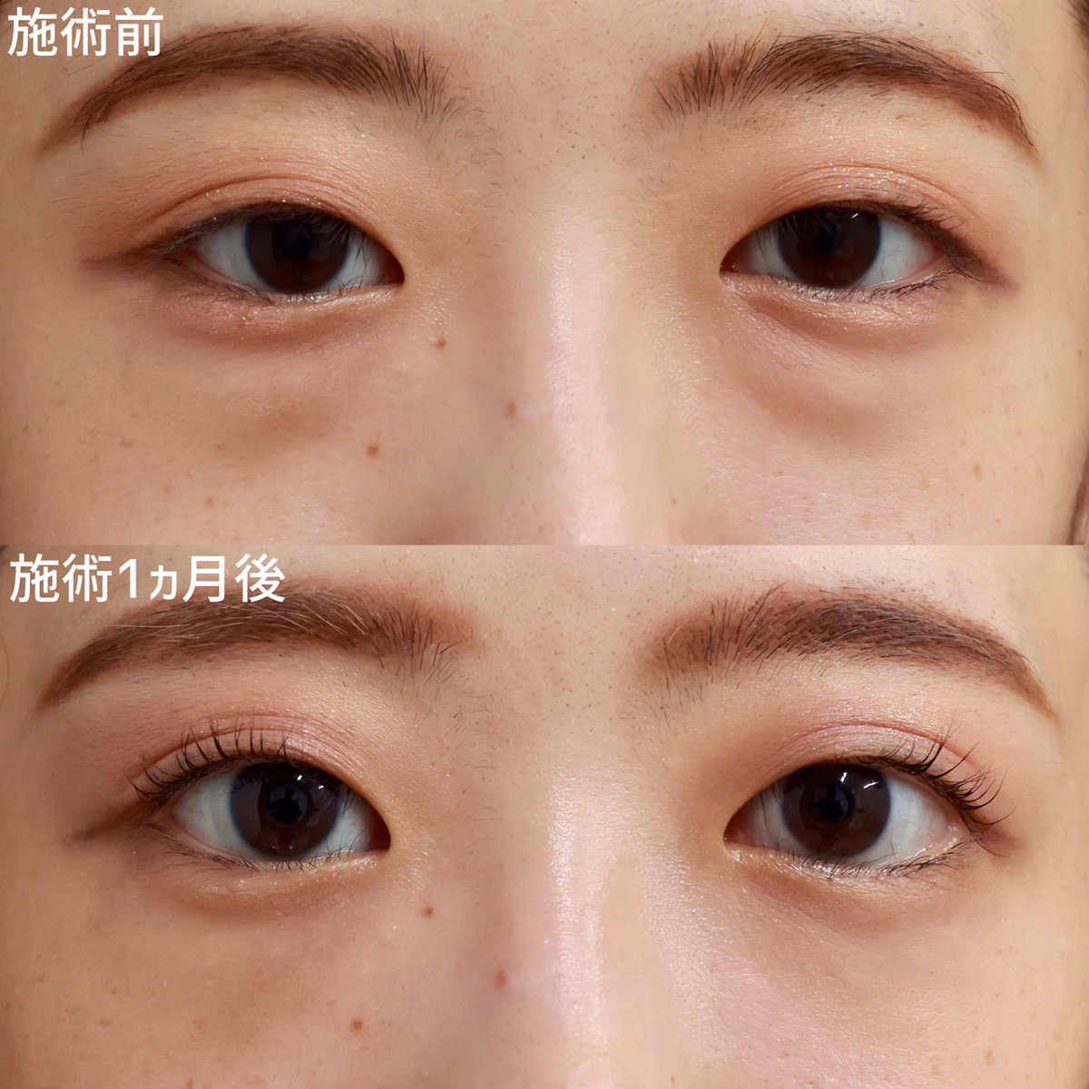 【裏ハムラ法】脂肪を移動させ、疲れた印象を改善！