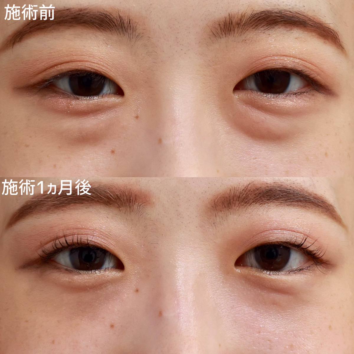 下眼瞼脱脂術（目の下のたるみ取り・目の下の脂肪ふくらみ取り）の症例写真 施術前後 