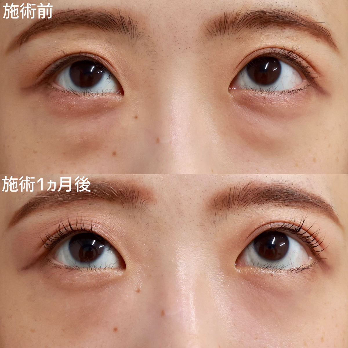 下眼瞼脱脂術（目の下のたるみ取り・目の下の脂肪ふくらみ取り）の症例写真 施術前後 
