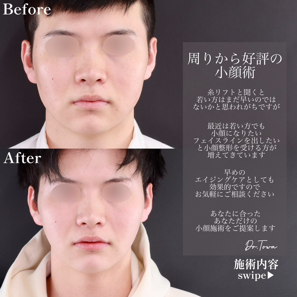 小顔整形｜パーフェクトフェイスライン/TAC式 ツヤ肌コラーゲンリフト®/顔の脂肪吸引の症例写真 施術前後 