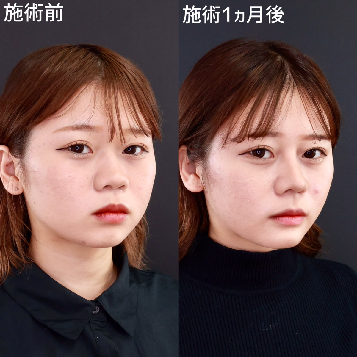 【鼻整形＋小顔整形】立体感が出てメリハリのあるお顔に