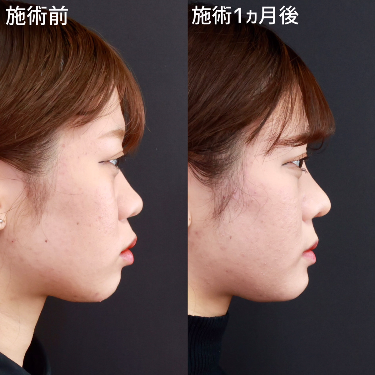 鼻中隔延長術/鼻先軟骨移植/鼻尖形成・鼻尖縮小の症例写真 施術前後 