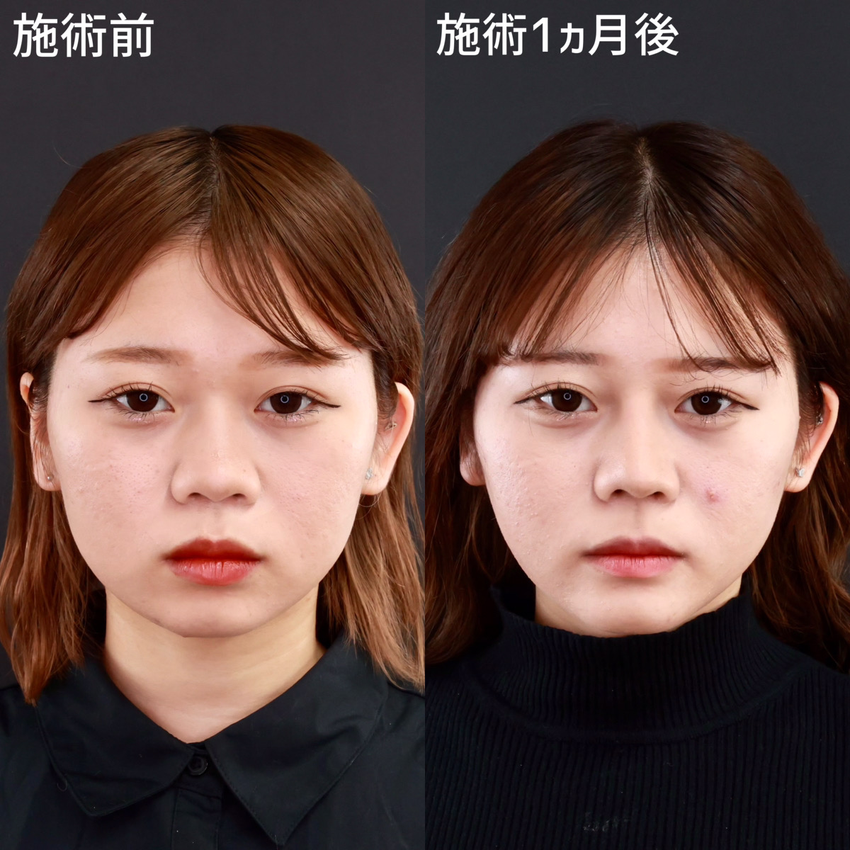 鼻中隔延長術/鼻先軟骨移植/鼻尖形成・鼻尖縮小の症例写真 施術前後 