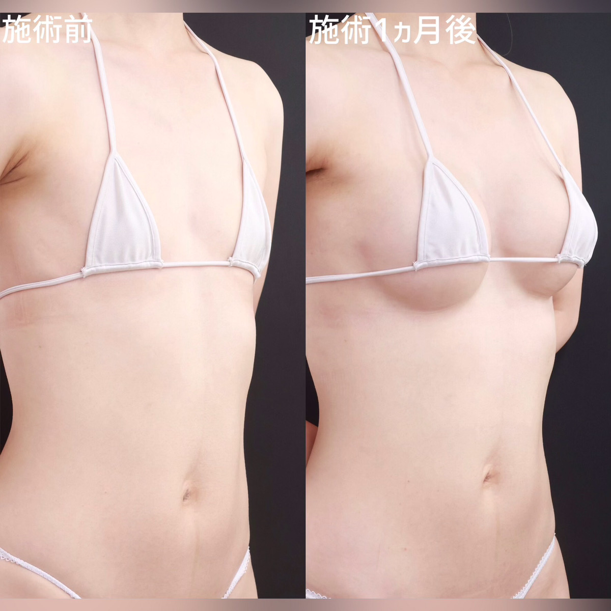 シリコンバッグ豊胸（人工乳腺バッグ）の症例写真 施術前後 