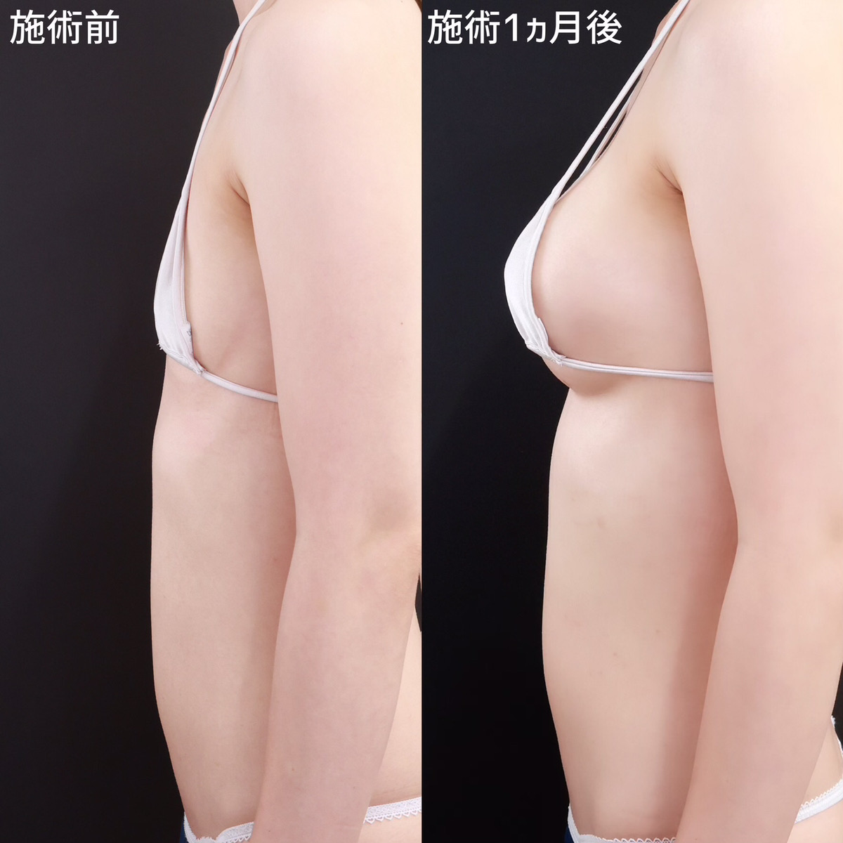 シリコンバッグ豊胸（人工乳腺バッグ）の症例写真 施術前後 