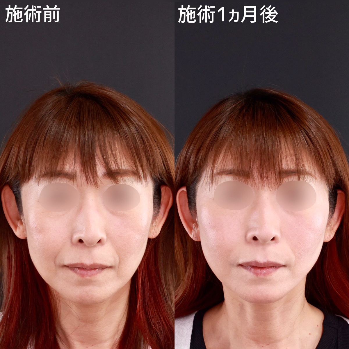 【糸リフト＋ヒアルロン酸注射】で見た目年齢が変わる！
