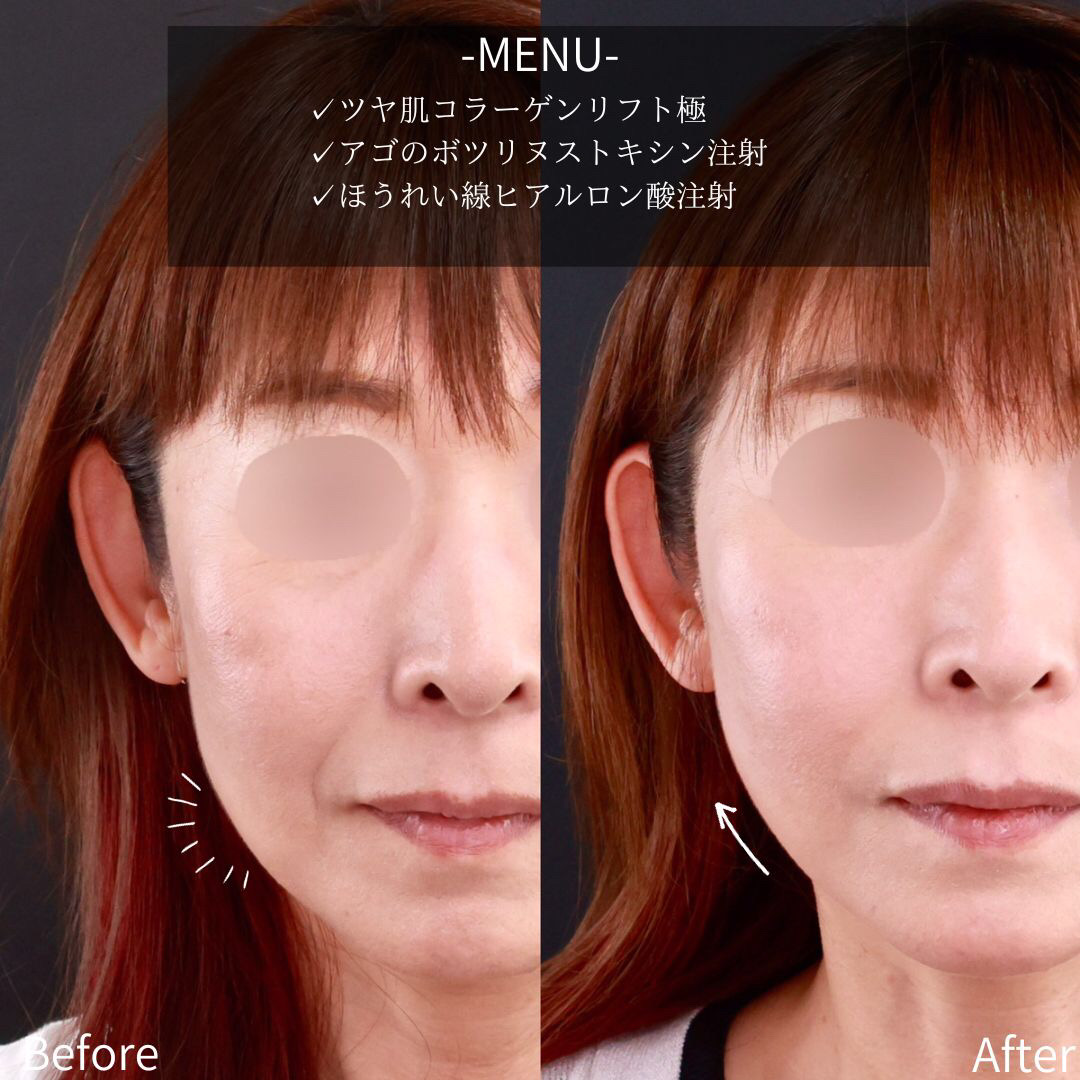 TAC式 ツヤ肌コラーゲンリフト®/ほうれい線のヒアルロン酸注射/ボトックス注射：その他の症例写真 施術前後 