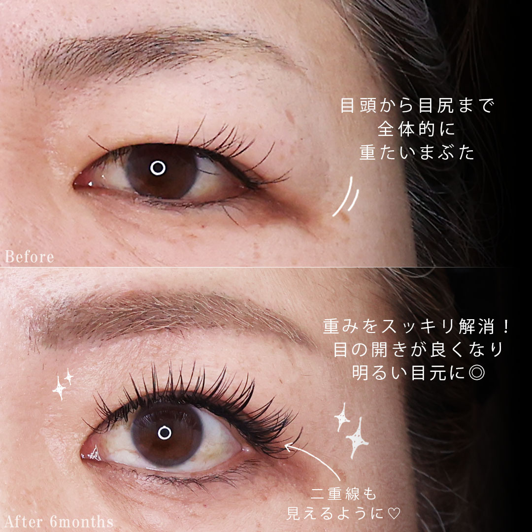 眉毛下切開術の症例写真 施術前後 