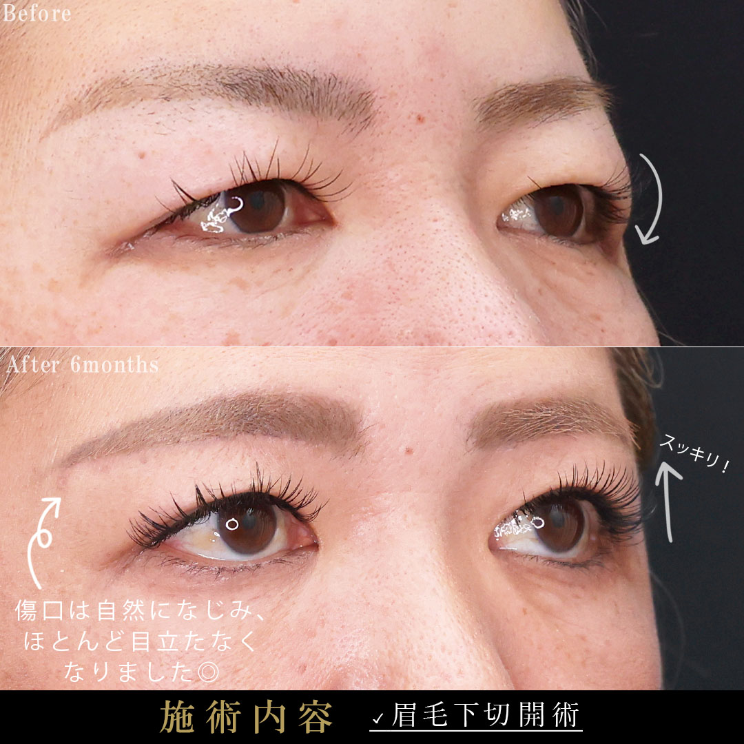 眉毛下切開術の症例写真 施術前後 