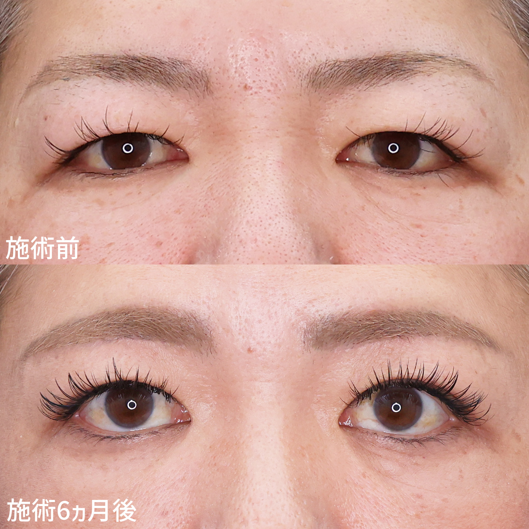 【眉毛下切開術】まぶたスッキリ！優しい目元に