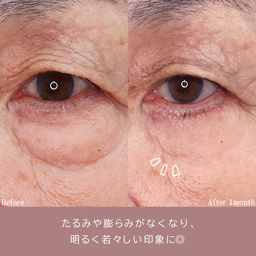 下眼瞼切開術（クマ・たるみとり）/下眼瞼脱脂術（目の下のたるみ取り・目の下の脂肪ふくらみ取り）の症例写真 施術前後 