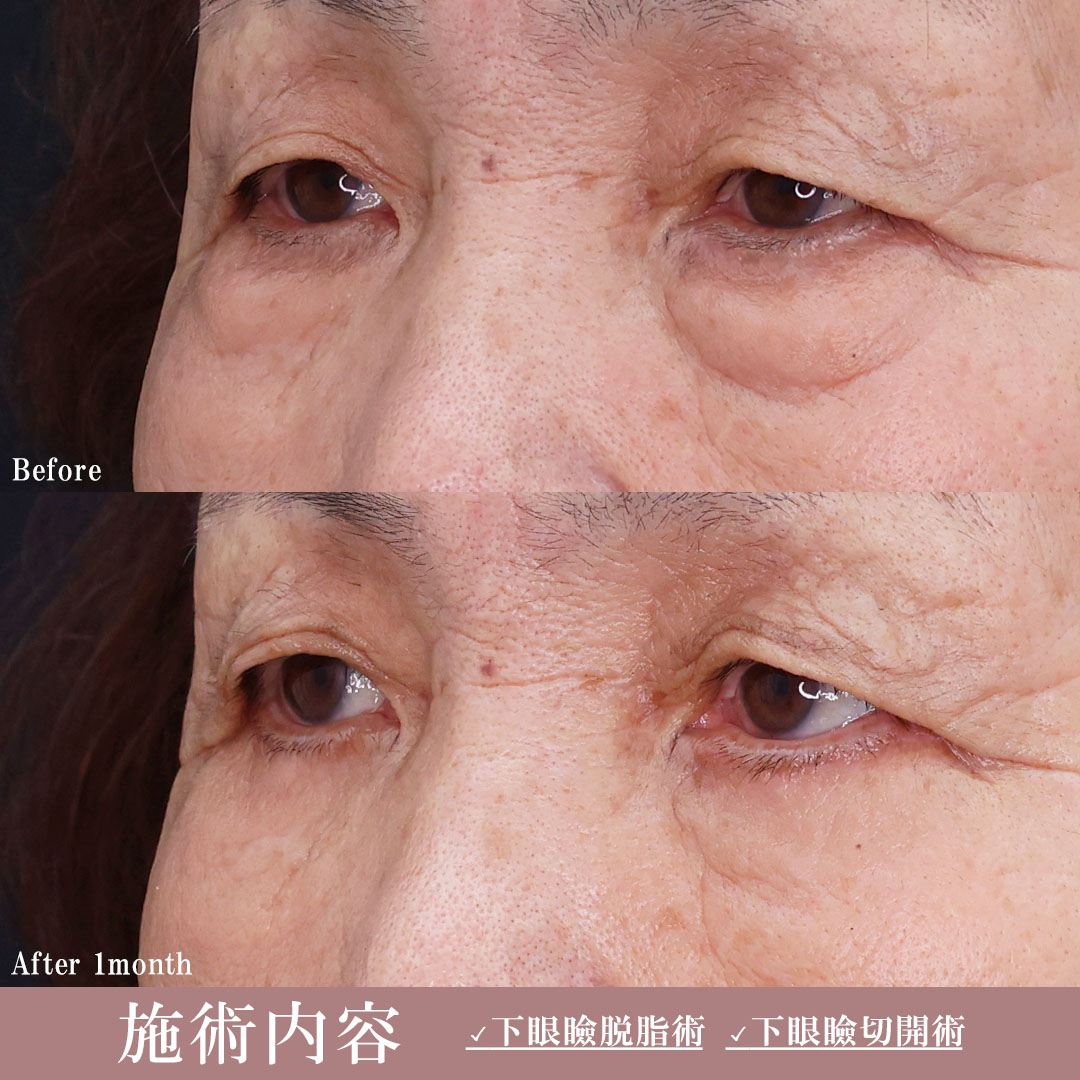 下眼瞼切開術（クマ・たるみとり）/下眼瞼脱脂術（目の下のたるみ取り・目の下の脂肪ふくらみ取り）の症例写真 施術前後 