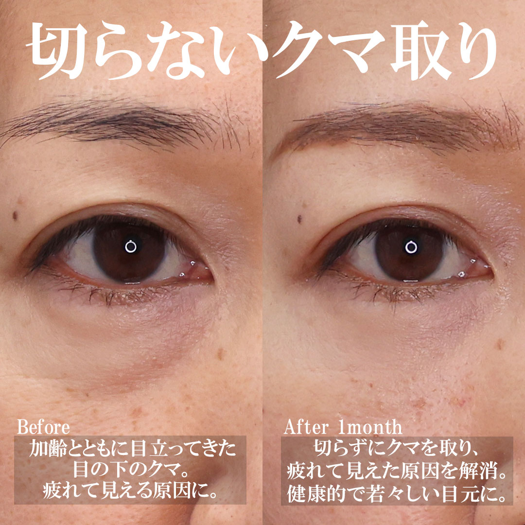 下眼瞼脱脂術（目の下のたるみ取り・目の下の脂肪ふくらみ取り）/目の下のヒアルロン酸注射の症例写真 施術前後 