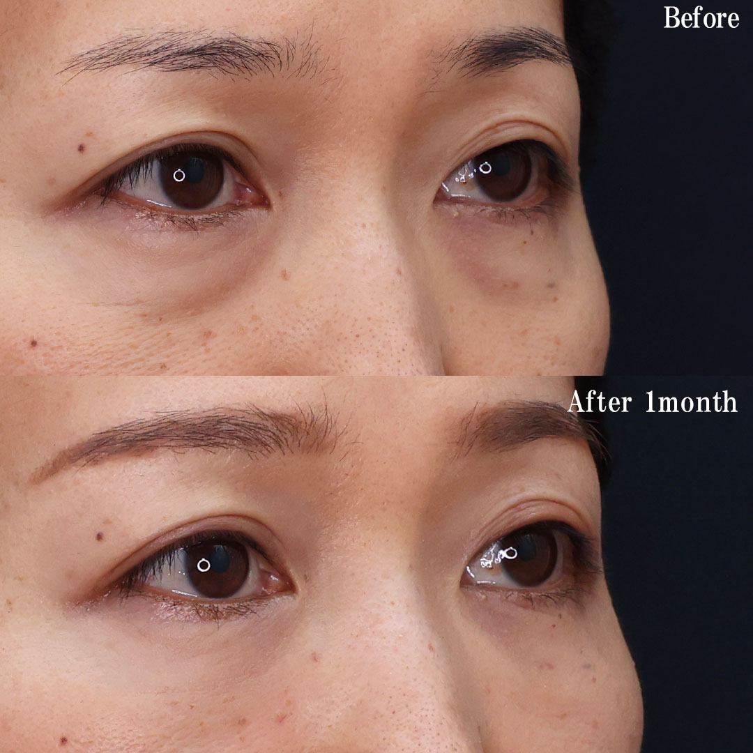 下眼瞼脱脂術（目の下のたるみ取り・目の下の脂肪ふくらみ取り）/目の下のヒアルロン酸注射の症例写真 施術前後 