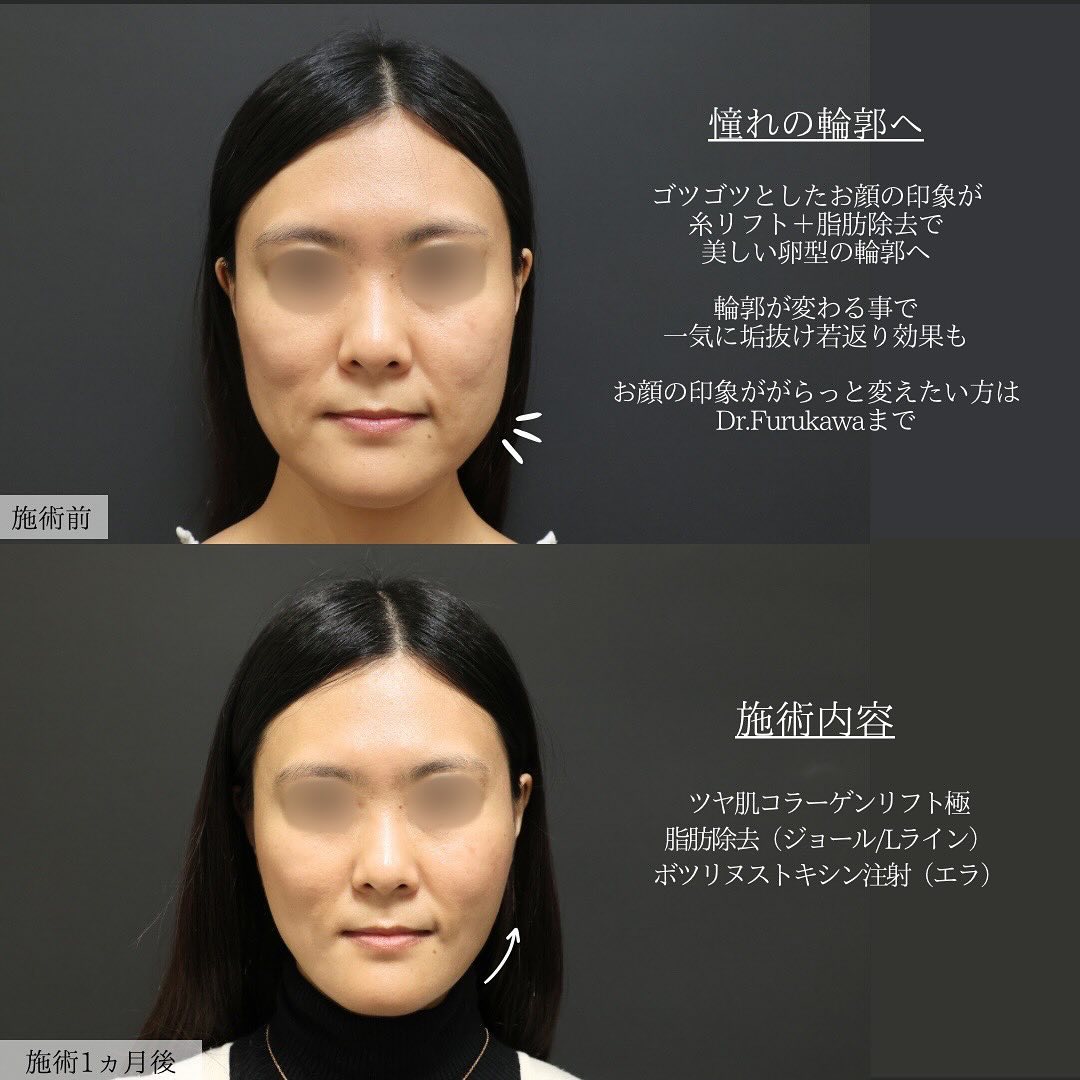 TAC式 ツヤ肌コラーゲンリフト®/ジョールファット除去/Lラインファット除去（エラ下脂肪除去）の症例写真 施術前後 
