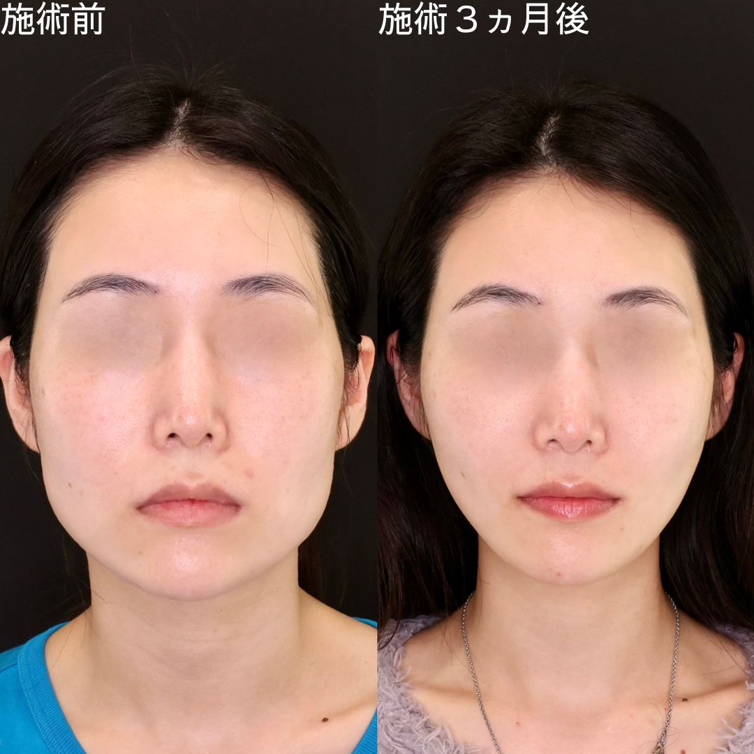 【糸リフト×脂肪除去】ベース型から卵型の輪郭に変化させる小顔術