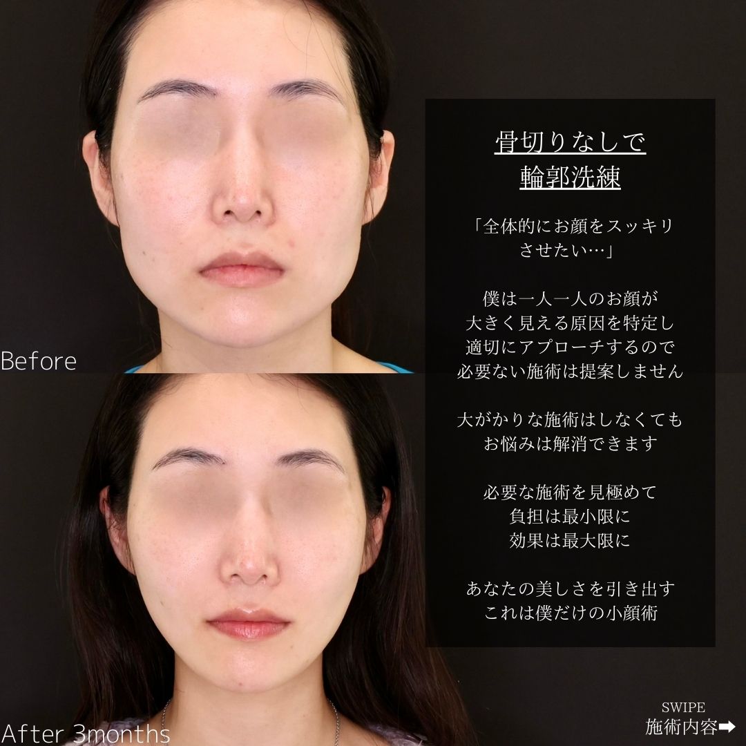 TAC式 ツヤ肌コラーゲンリフト®/メーラーファット除去の症例写真 施術前後 