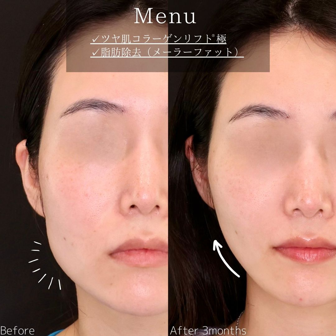 TAC式 ツヤ肌コラーゲンリフト®/メーラーファット除去の症例写真 施術前後 