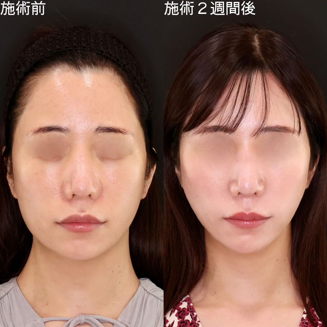 【糸リフト】憧れの卵型輪郭を糸リフトでデザイン