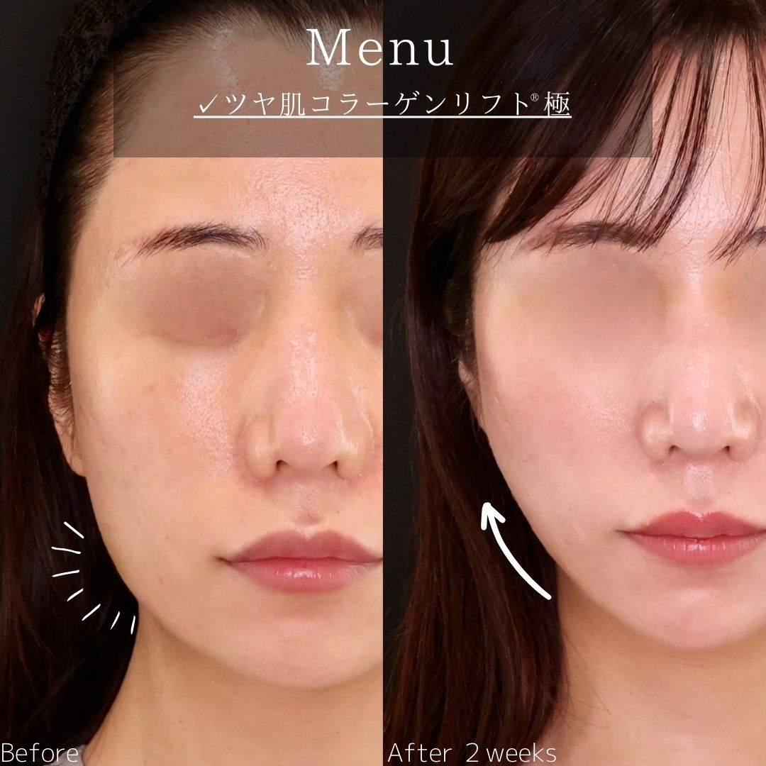 TAC式 ツヤ肌コラーゲンリフト®の症例写真 施術前後 