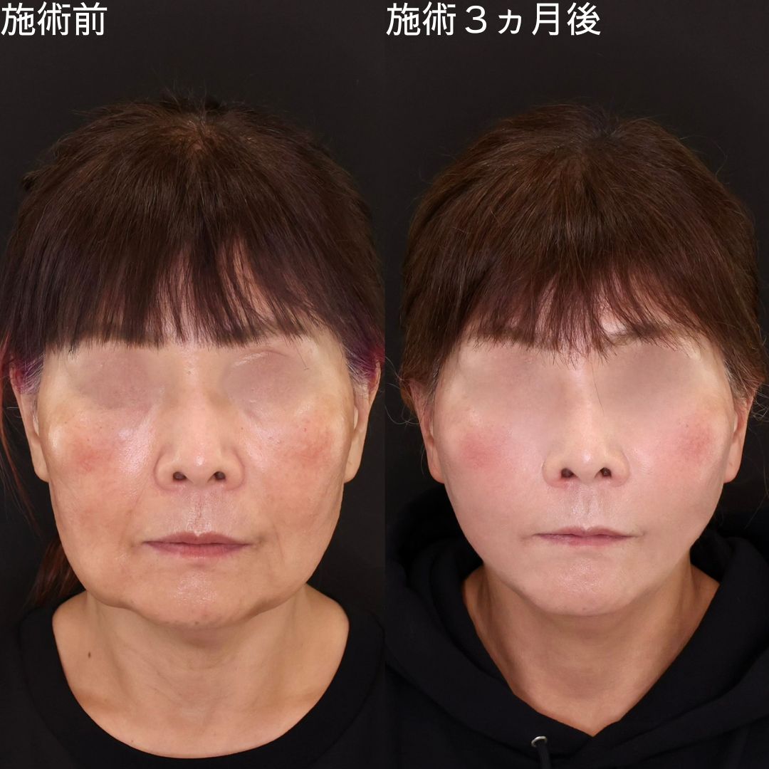TAC式 ツヤ肌コラーゲンリフト®/ジョールファット除去の症例写真 施術前後 
