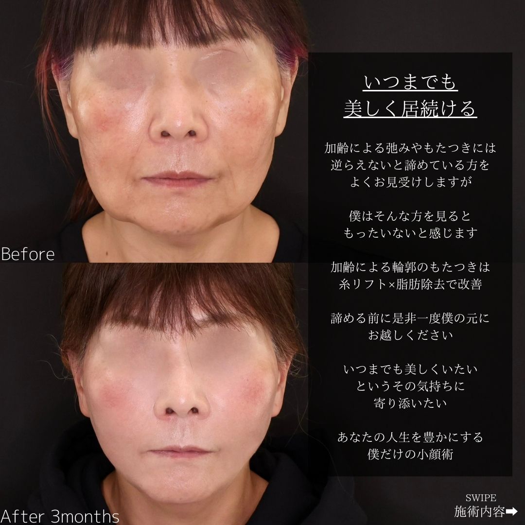TAC式 ツヤ肌コラーゲンリフト®/ジョールファット除去の症例写真 施術前後 