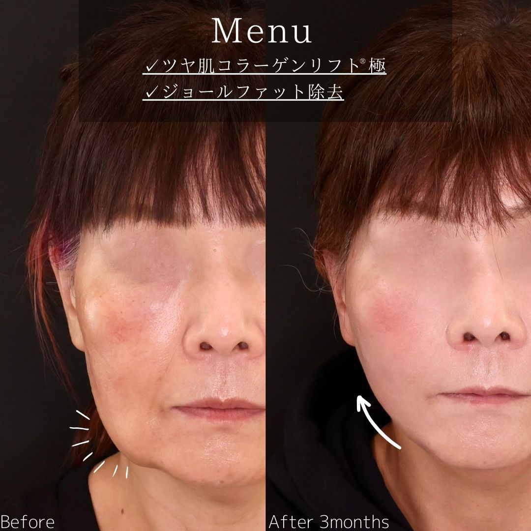 TAC式 ツヤ肌コラーゲンリフト®/ジョールファット除去の症例写真 施術前後 
