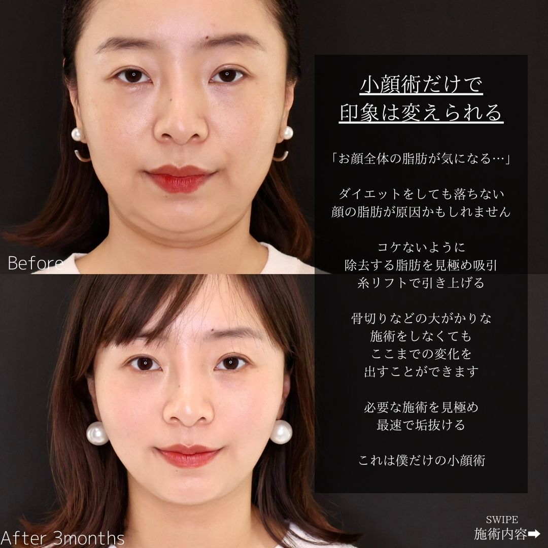 TAC式 ツヤ肌コラーゲンリフト®/顎下の脂肪吸引/バッカルファット除去の症例写真 施術前後 