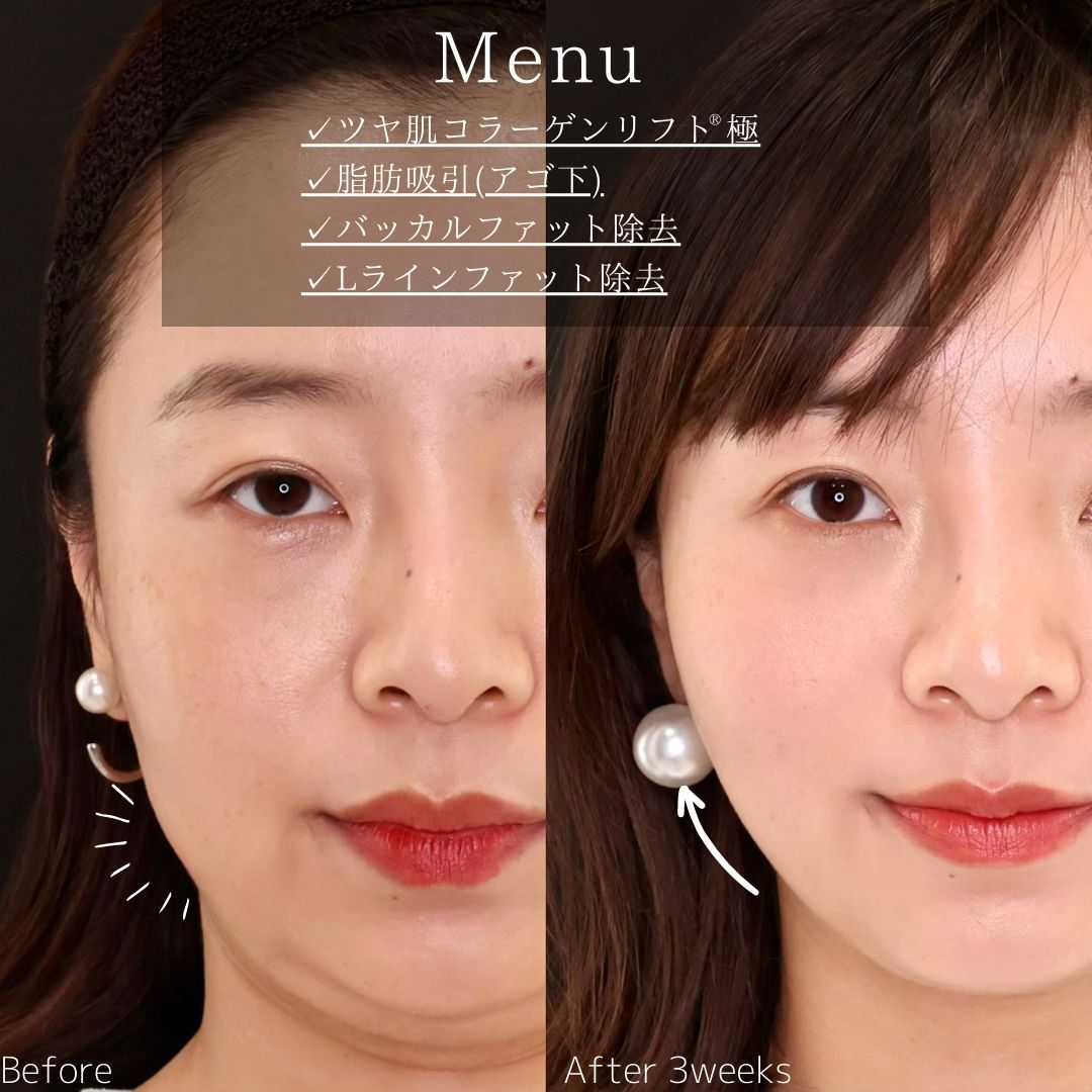 TAC式 ツヤ肌コラーゲンリフト®/顎下の脂肪吸引/バッカルファット除去の症例写真 施術前後 